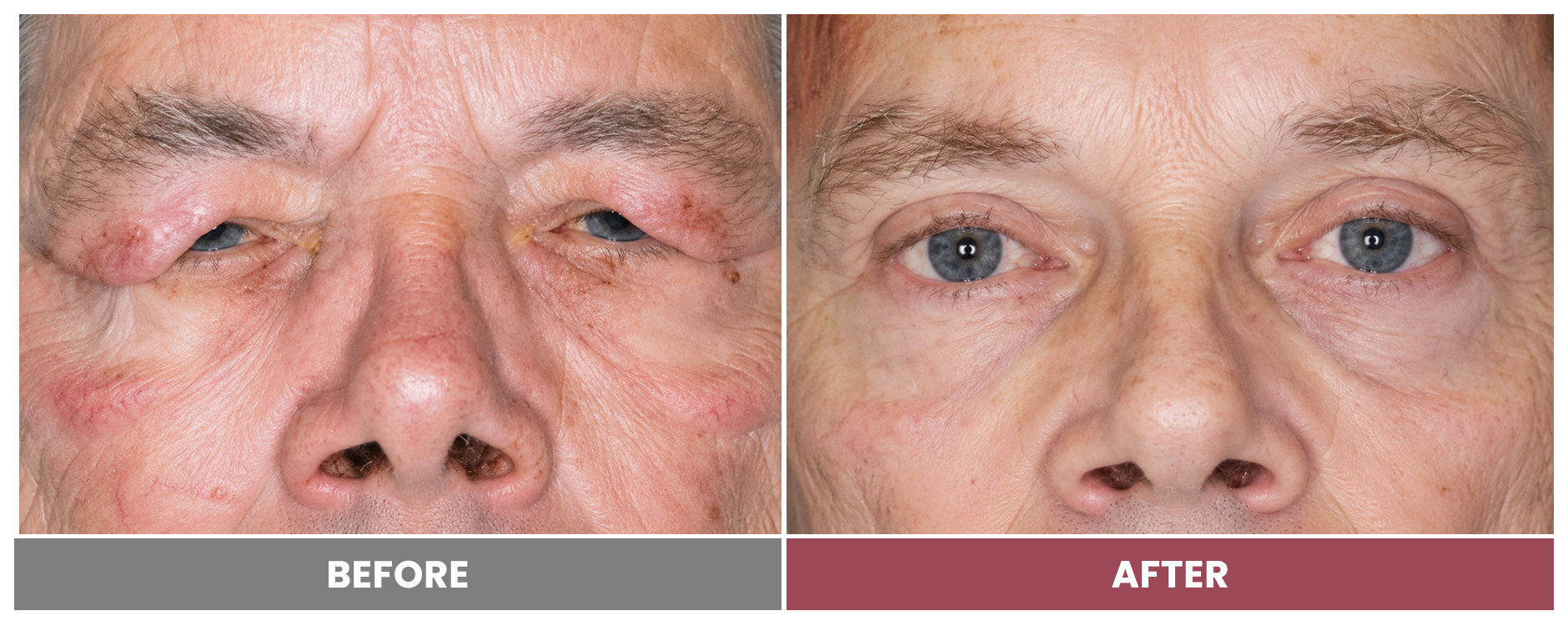 Upper Blepharoplasty - Case 94